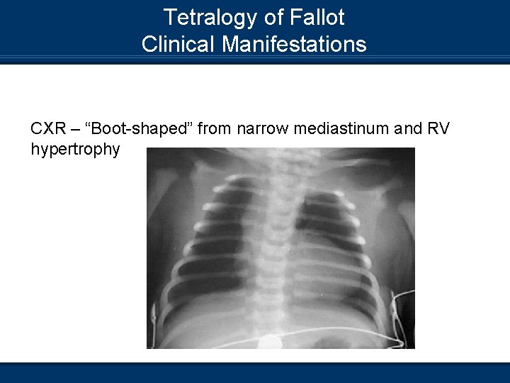 Tetralogy of Fallot Clinical Manifestations CXR – “Boot-shaped” from narrow mediastinum and RV hypertrophy