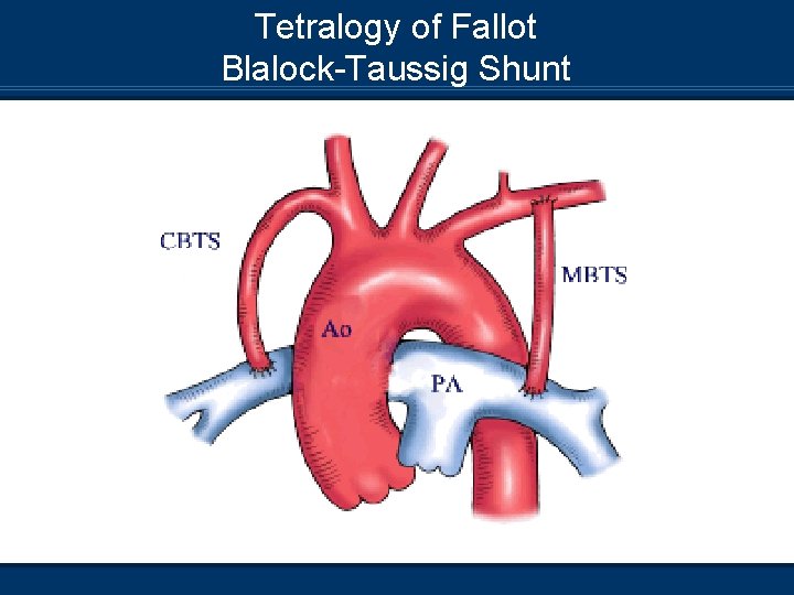 Tetralogy of Fallot Blalock-Taussig Shunt 