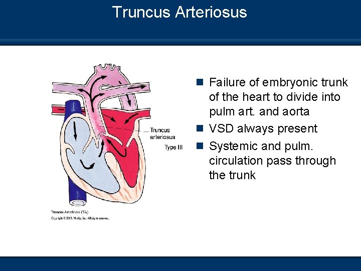 Truncus Arteriosus n Failure of embryonic trunk of the heart to divide into pulm