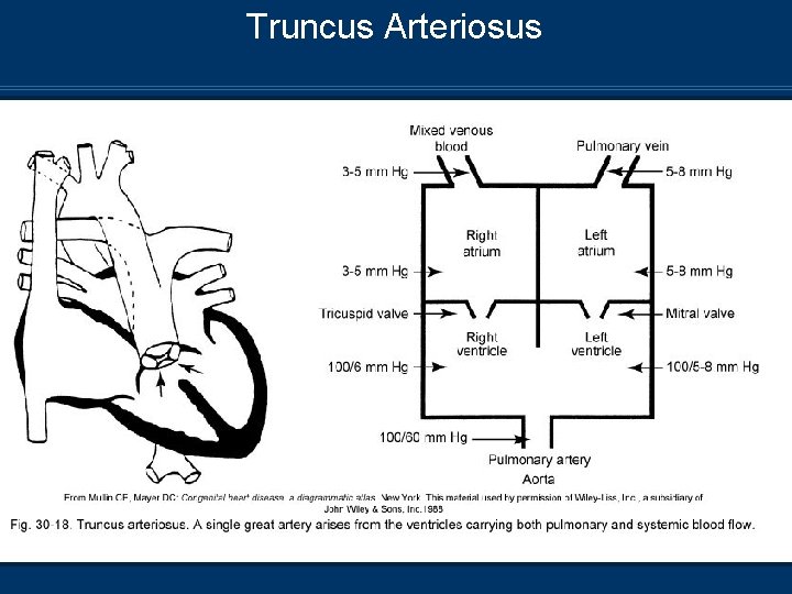Truncus Arteriosus 