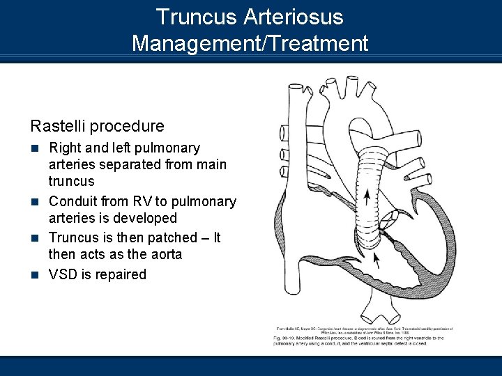 Truncus Arteriosus Management/Treatment Rastelli procedure n Right and left pulmonary arteries separated from main