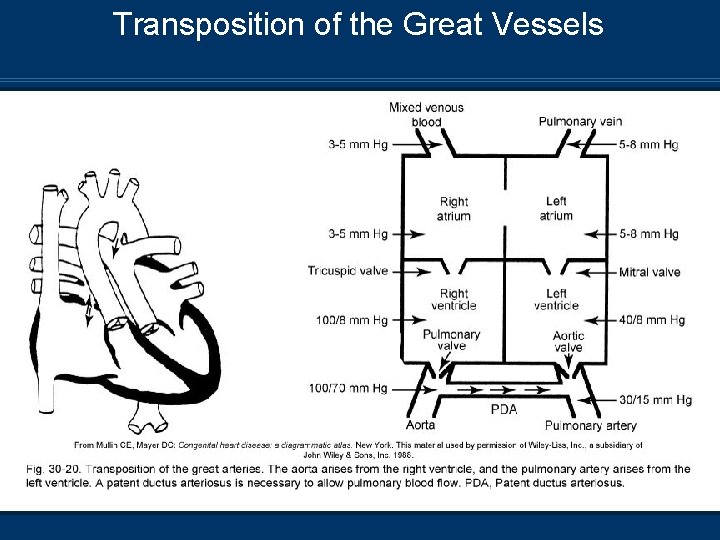 Transposition of the Great Vessels 