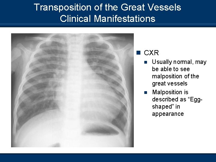 Transposition of the Great Vessels Clinical Manifestations n CXR Usually normal, may be able