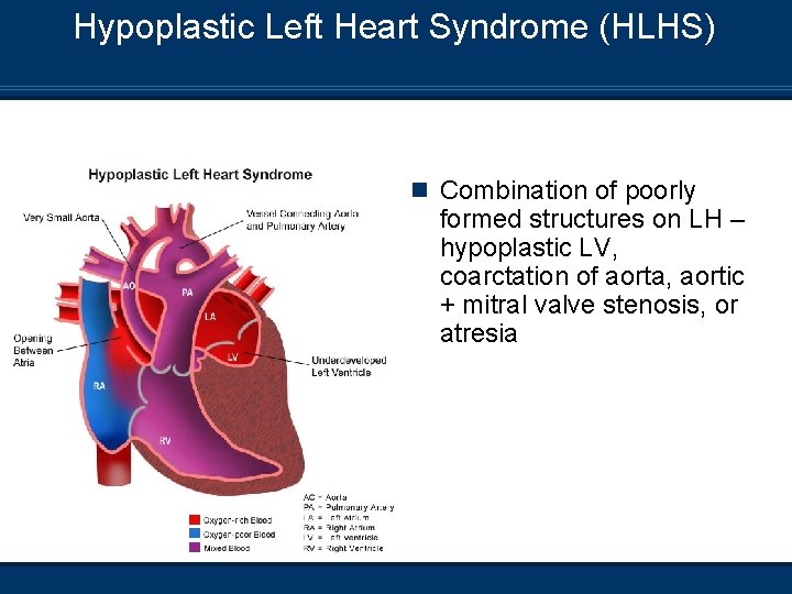 Hypoplastic Left Heart Syndrome (HLHS) n Combination of poorly formed structures on LH –
