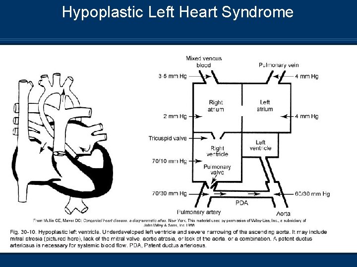 Hypoplastic Left Heart Syndrome 