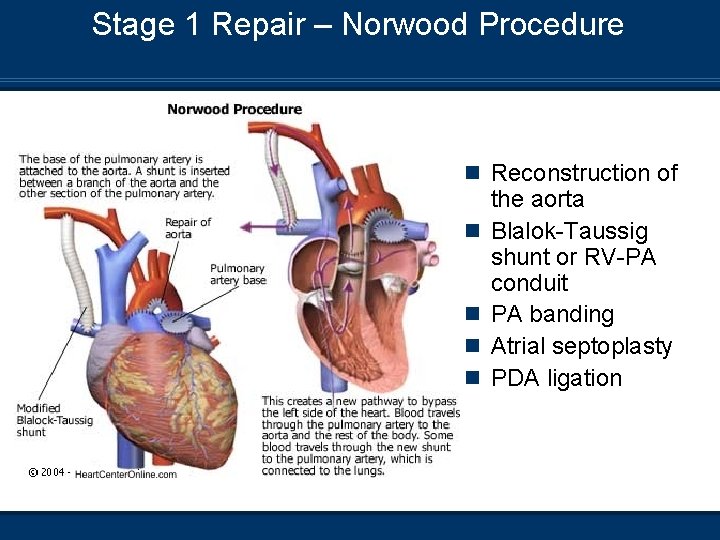 Stage 1 Repair – Norwood Procedure n Reconstruction of n n the aorta Blalok-Taussig