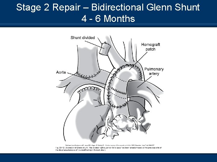 Stage 2 Repair – Bidirectional Glenn Shunt 4 - 6 Months 