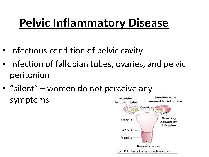 Pelvic Inflammatory Disease • Infectious condition of pelvic cavity • Infection of fallopian tubes,