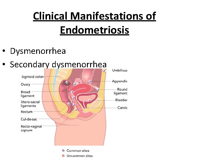 Clinical Manifestations of Endometriosis • Dysmenorrhea • Secondary dysmenorrhea 
