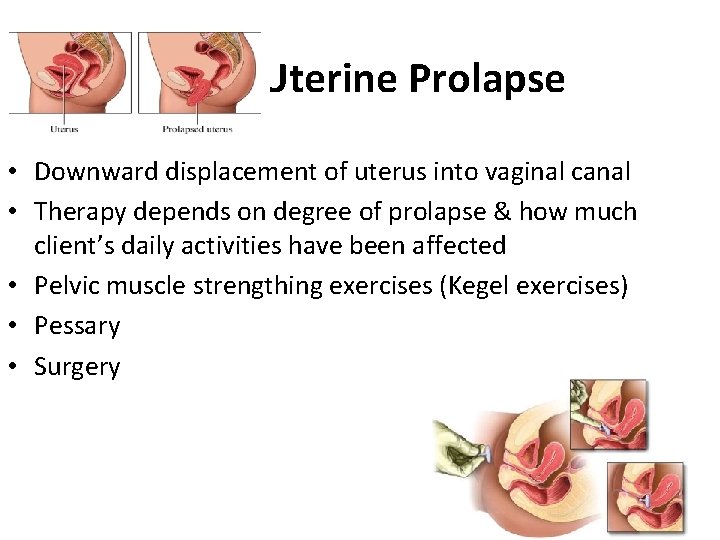 Uterine Prolapse • Downward displacement of uterus into vaginal canal • Therapy depends on