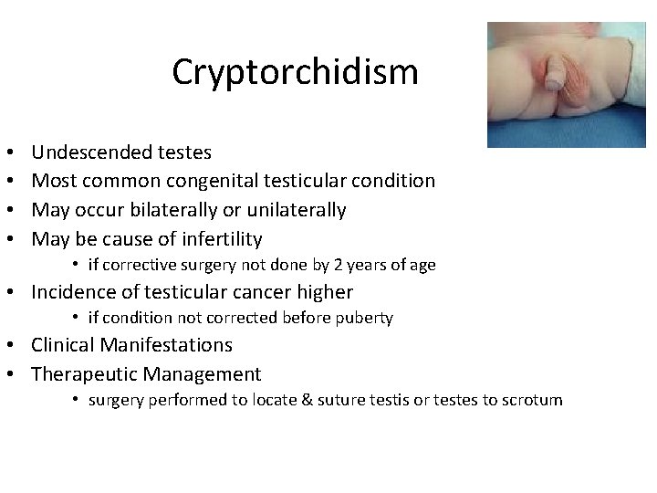 Cryptorchidism • • Undescended testes Most common congenital testicular condition May occur bilaterally or