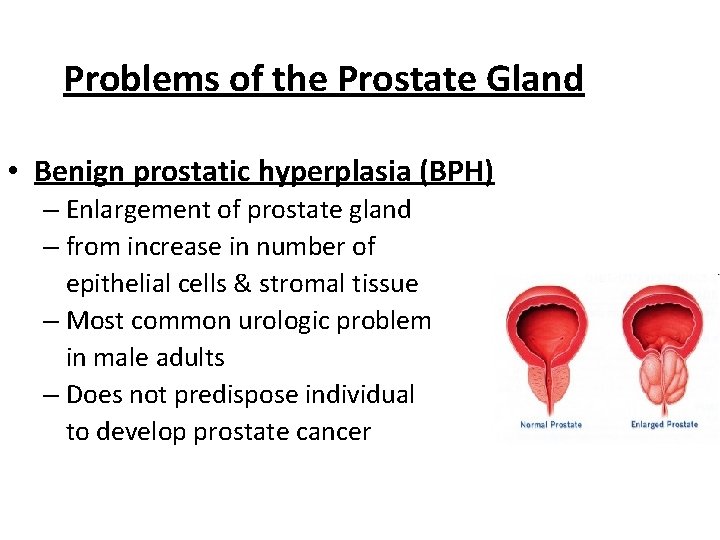 Problems of the Prostate Gland • Benign prostatic hyperplasia (BPH) – Enlargement of prostate