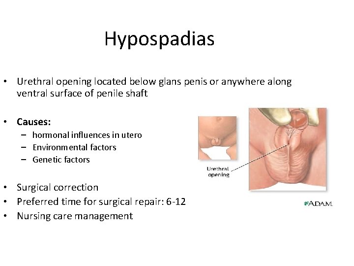 Hypospadias • Urethral opening located below glans penis or anywhere along ventral surface of