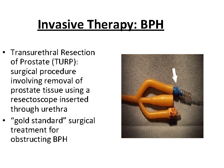 Invasive Therapy: BPH • Transurethral Resection of Prostate (TURP): surgical procedure involving removal of