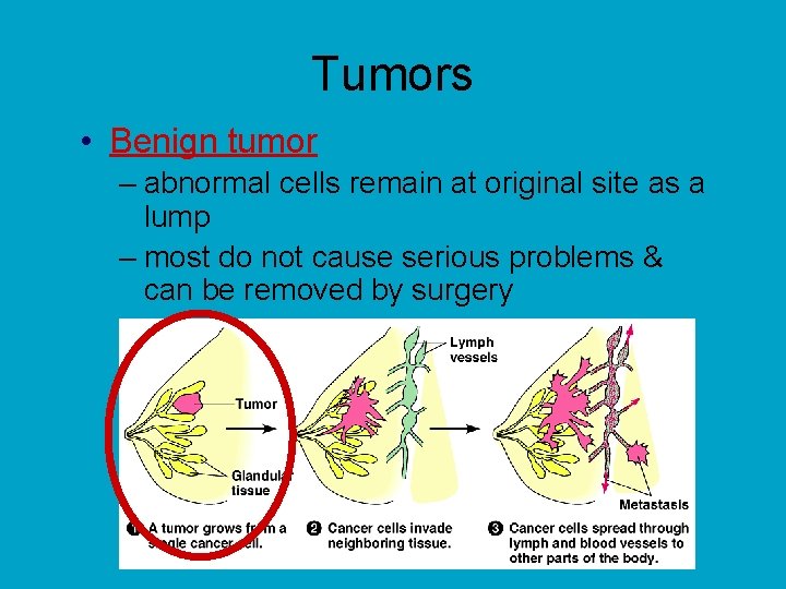 Tumors • Benign tumor – abnormal cells remain at original site as a lump