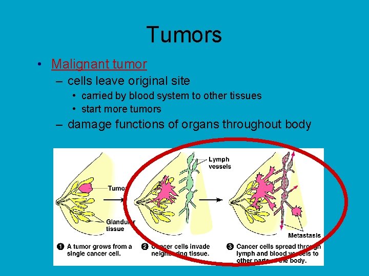 Tumors • Malignant tumor – cells leave original site • carried by blood system