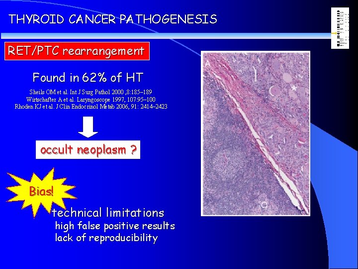 THYROID CANCER PATHOGENESIS RET/PTC rearrangement Found in 62% of HT Sheils OM et al.