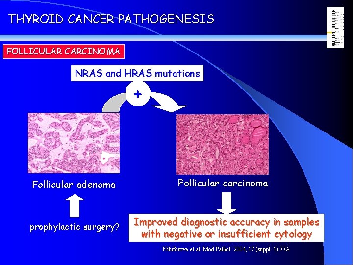 THYROID CANCER PATHOGENESIS FOLLICULAR CARCINOMA NRAS and HRAS mutations + Follicular adenoma prophylactic surgery?