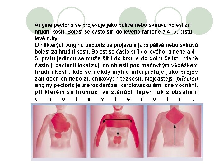 Angina pectoris se projevuje jako pálivá nebo svíravá bolest za hrudní kostí. Bolest se