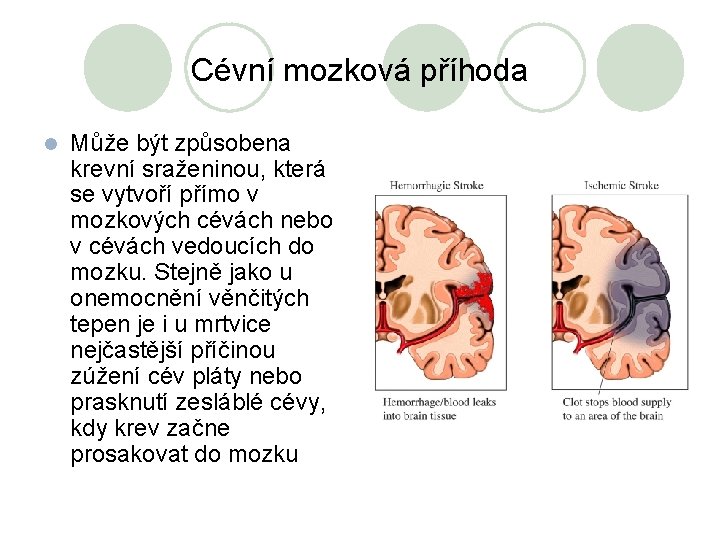 Cévní mozková příhoda l Může být způsobena krevní sraženinou, která se vytvoří přímo v