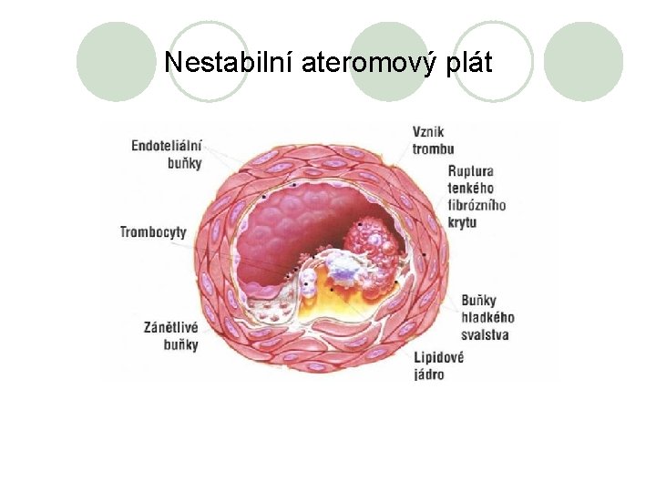 Nestabilní ateromový plát 