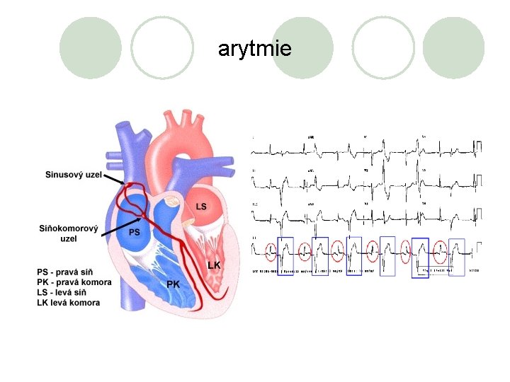 arytmie 