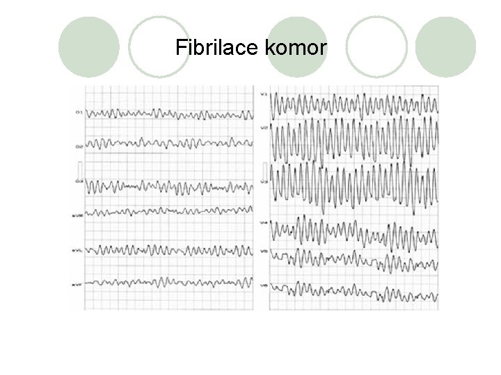 Fibrilace komor 