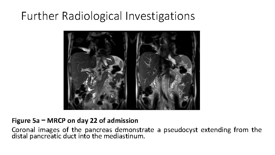 Further Radiological Investigations Figure 5 a – MRCP on day 22 of admission Coronal