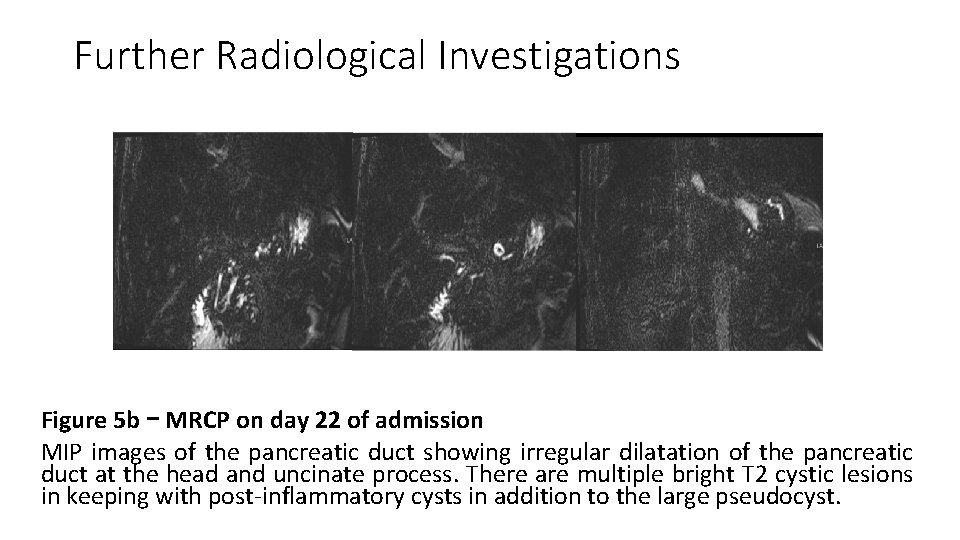 Further Radiological Investigations Figure 5 b – MRCP on day 22 of admission MIP