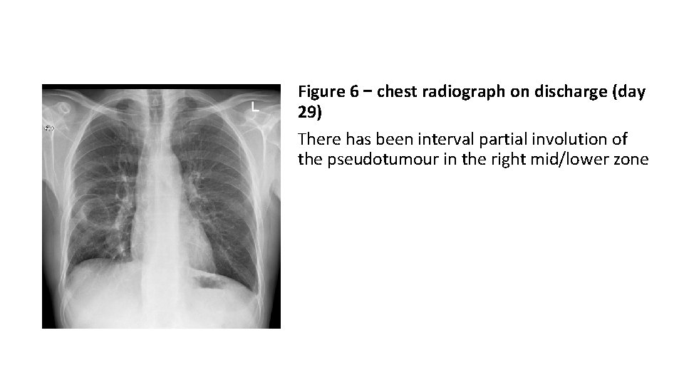 Figure 6 – chest radiograph on discharge (day 29) There has been interval partial