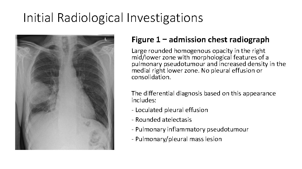 Initial Radiological Investigations Figure 1 – admission chest radiograph Large rounded homogenous opacity in