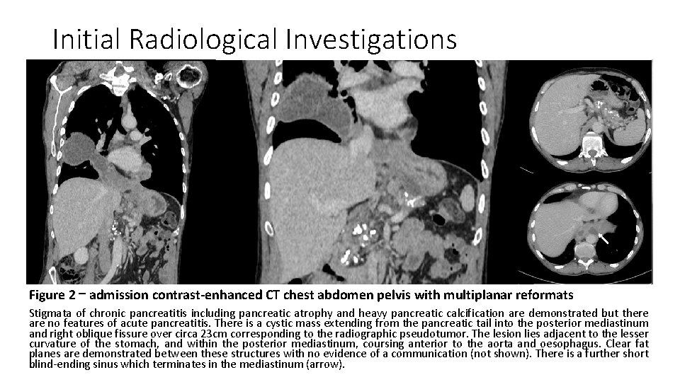 Initial Radiological Investigations Figure 2 – admission contrast-enhanced CT chest abdomen pelvis with multiplanar