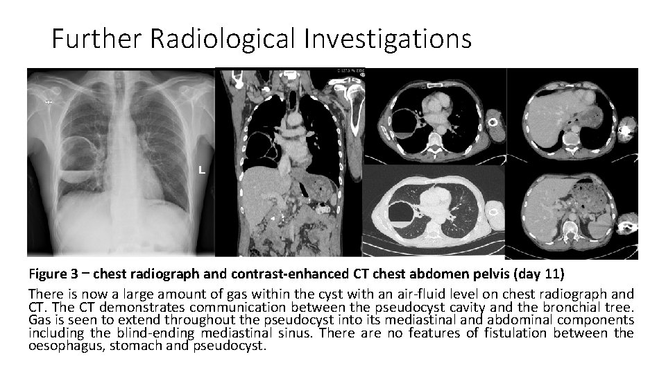 Further Radiological Investigations Figure 3 – chest radiograph and contrast-enhanced CT chest abdomen pelvis