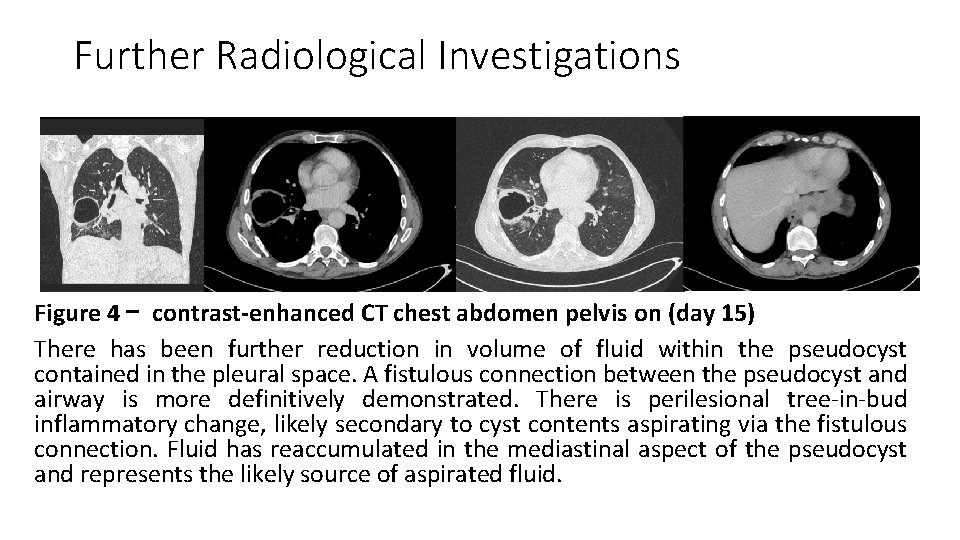 Further Radiological Investigations Figure 4 – contrast-enhanced CT chest abdomen pelvis on (day 15)