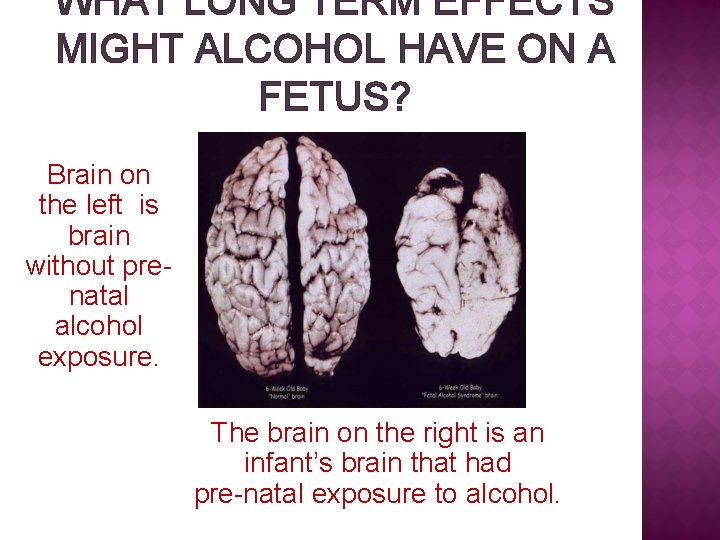 WHAT LONG TERM EFFECTS MIGHT ALCOHOL HAVE ON A FETUS? Brain on the left