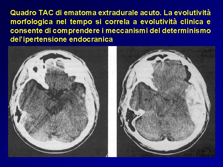 Quadro TAC di ematoma extradurale acuto. La evolutività morfologica nel tempo si correla a