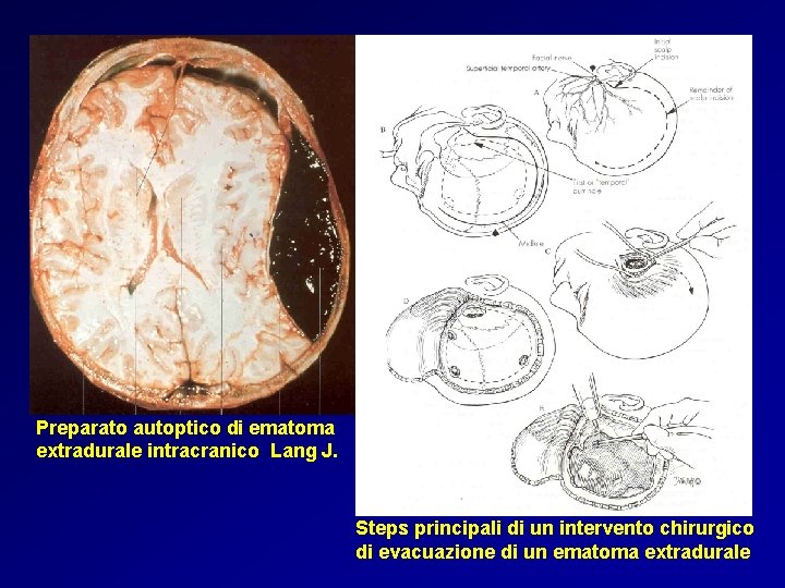 Preparato autoptico di ematoma extradurale intracranico Lang J. Steps principali di un intervento chirurgico