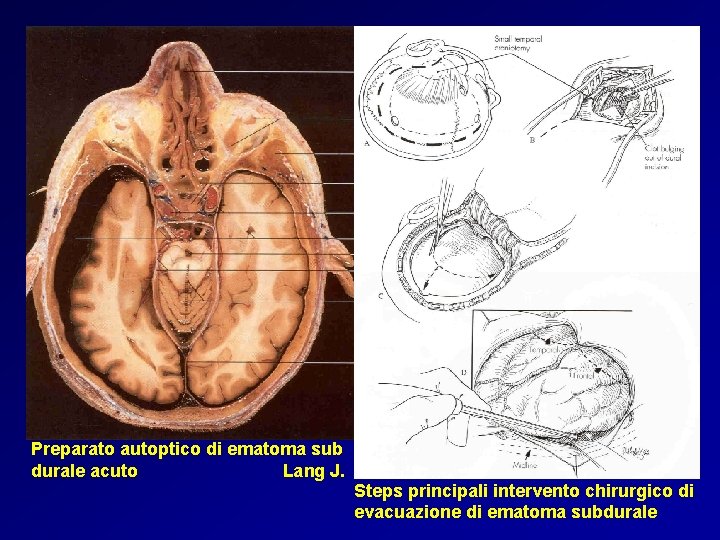 Preparato autoptico di ematoma sub durale acuto Lang J. Steps principali intervento chirurgico di