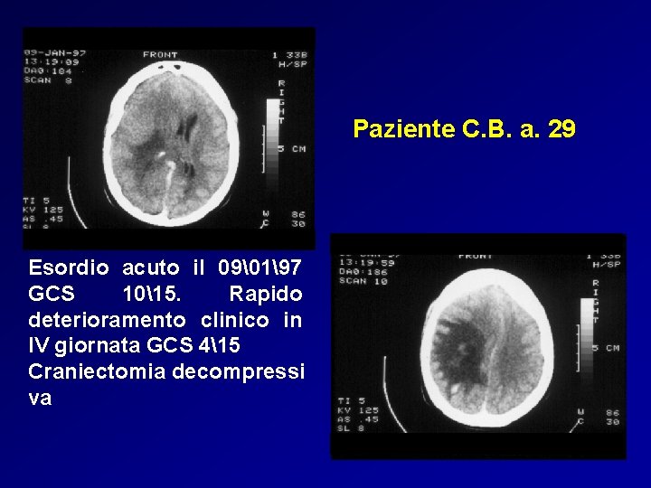 Paziente C. B. a. 29 Esordio acuto il 09�197 GCS 1015. Rapido deterioramento clinico