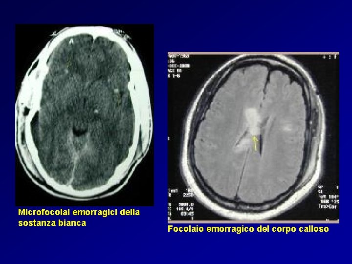 Microfocolai emorragici della sostanza bianca Focolaio emorragico del corpo calloso 