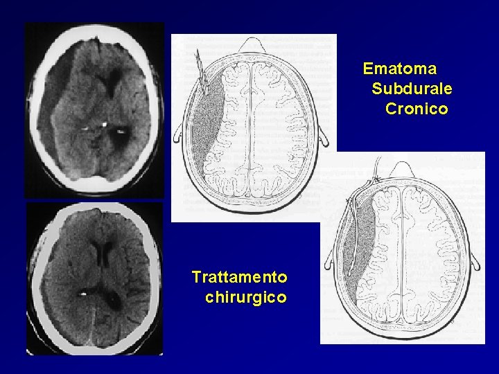 Ematoma Subdurale Cronico Trattamento chirurgico 