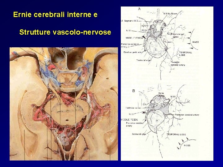 Ernie cerebrali interne e Strutture vascolo-nervose 