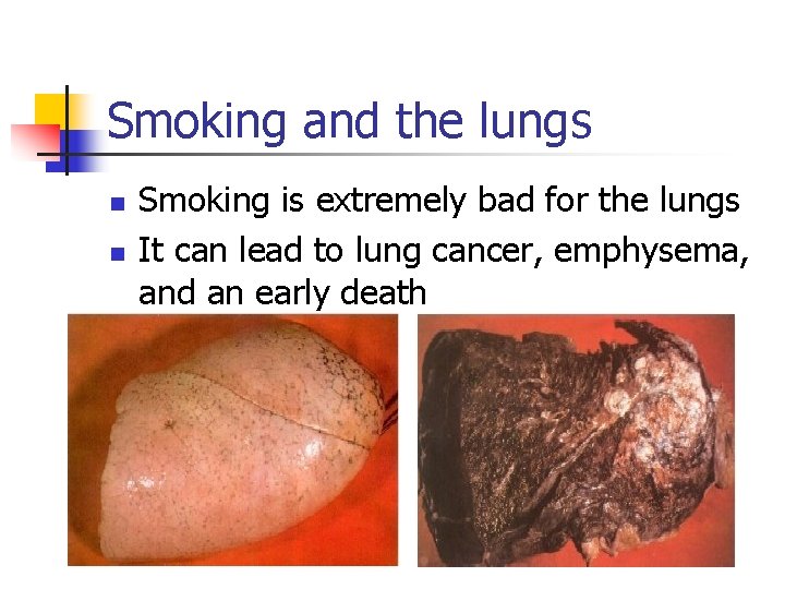 Smoking and the lungs n n Smoking is extremely bad for the lungs It