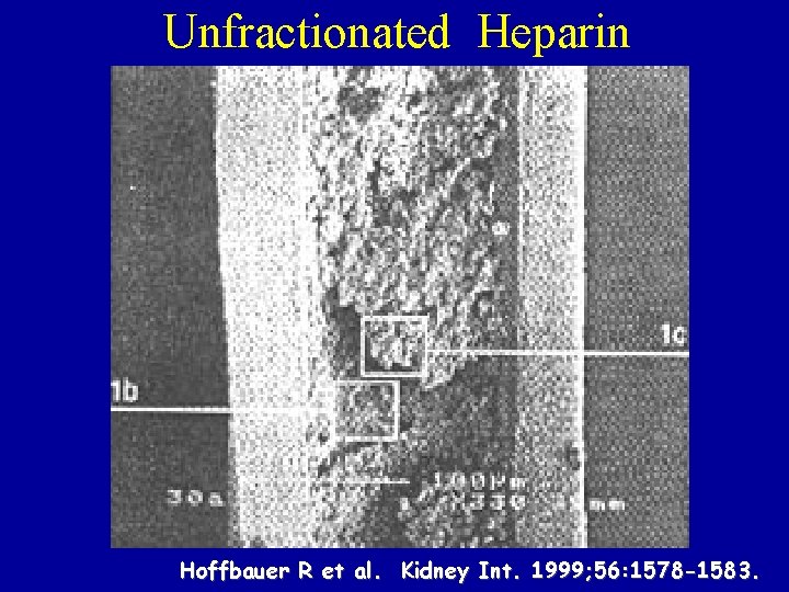 Unfractionated Heparin Hoffbauer R et al. Kidney Int. 1999; 56: 1578 -1583. 