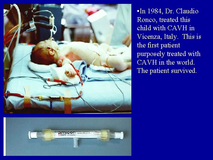  • In 1984, Dr. Claudio Ronco, treated this child with CAVH in Vicenza,