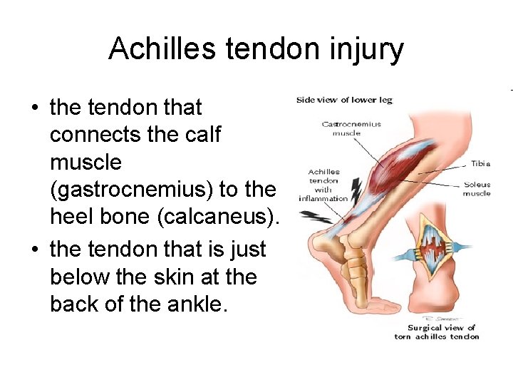 Achilles tendon injury • the tendon that connects the calf muscle (gastrocnemius) to the