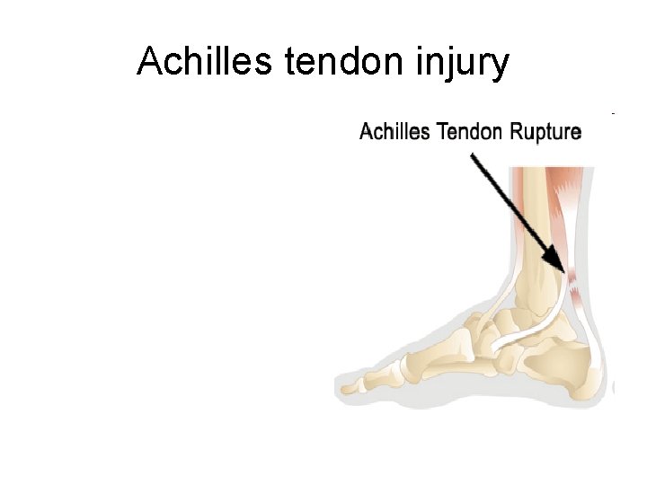 Achilles tendon injury 