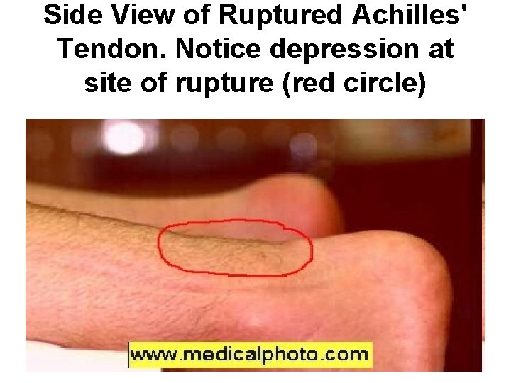 Side View of Ruptured Achilles' Tendon. Notice depression at site of rupture (red circle)