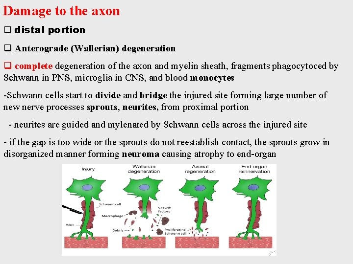 Damage to the axon q distal portion q Anterograde (Wallerian) degeneration q complete degeneration