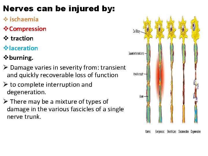 Nerves can be injured by: v ischaemia v. Compression v traction vlaceration vburning. Ø